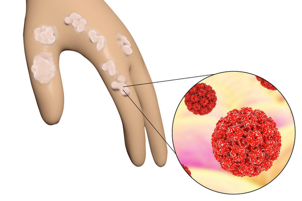 Main avec verrues et vue rapprochée du papillomavirus qui provoque le développement de verrues, illustration 3D - Photo, image