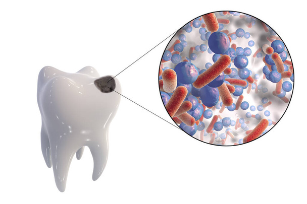 歯のケアとケア、 3Dイラストを引き起こす微生物のクローズアップビューを持つ歯 - 写真・画像