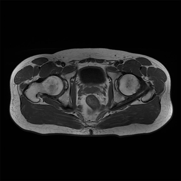 Magnetic resonance imaging of the male hip - cross section. Observed changes in osteoarthritis in the right hip. - Photo, Image