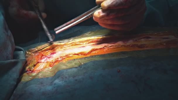 Cousu la peau après une opération sur le patient malade après avoir effectué une chirurgie grave - Séquence, vidéo