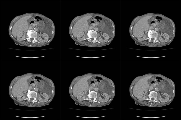 CT Scan Tomografia computadorizada de abdômen inteiro com contraste. Tomografia computadorizada TC de abdome total em Axial. Parte vinte - Foto, Imagem