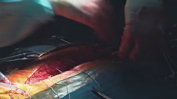Lääkäri lähikuva rinnassa leikkauksen jälkeen ommel - Materiaali, video