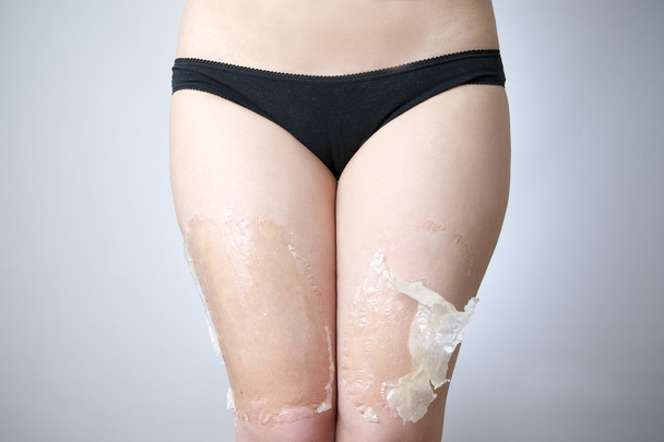 Mask for skin thighs against stretch marks and cellulite - Fotoğraf, Görsel