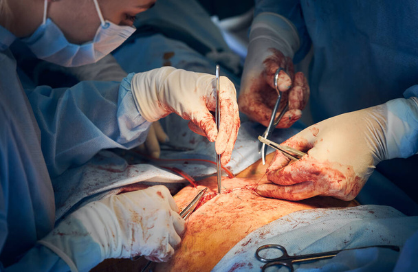 入院中のおなかタック手術後の縫合をする手袋をして医師と助手のクローズアップ。腹部形成手術を行う医療従事者。腹部形成術・美容整形の概念. - 写真・画像