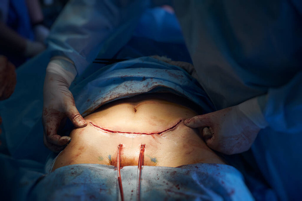 Zamknij ręce chirurga plastycznego dotykając brzucha pacjenta nacięciem po operacji plastycznej brzucha. Pracownik medyczny sprawdza szwy na brzuchu kobiety po operacji plastycznej. Pojęcie plastyki brzucha. - Zdjęcie, obraz