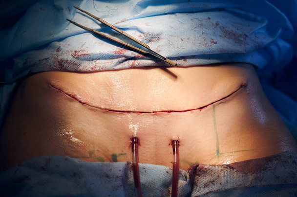 Gros plan du ventre féminin avec une ligne de suture après la chirurgie du ventre et des pinces. Patient avec point chirurgical couché après une chirurgie plastique abdominale. Concept d'abdominoplastie et de chirurgie esthétique. - Photo, image