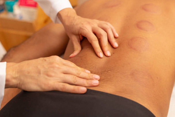 Detalle de manos del terapeuta dando masaje de espalda al paciente con marcas de ventosa. - Foto, imagen