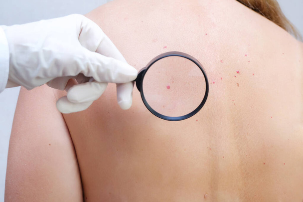 doctor examines the growths on the skin of an adult with a magnifying glass, diagnosis of skin cancer. Hemangioma, angioma, papilloma, mole - Photo, Image