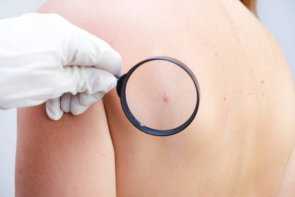 doctor examines the growths on the skin of an adult with a magnifying glass, diagnosis of skin cancer. Hemangioma, angioma, papilloma, mole - Foto, immagini