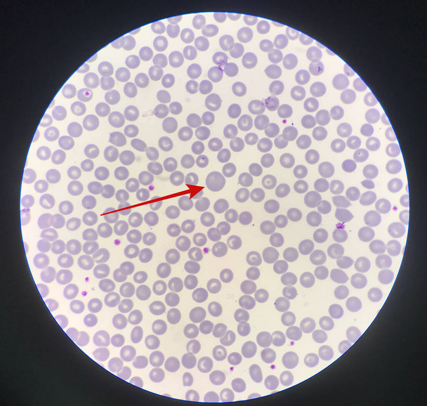 Czerwona strzałka pokazuje rozmaz krwi w centrum czerwonych krwinek. - Zdjęcie, obraz