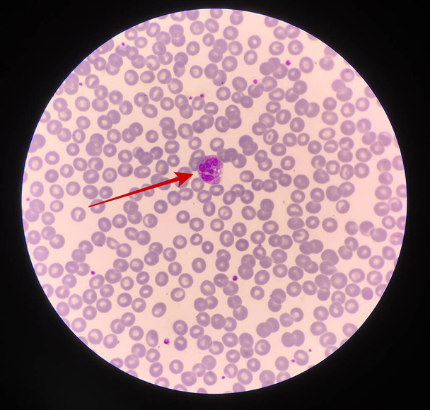 Flecha roja mostrando neutrófilo con gránulo tóxico activo PMN. - Foto, imagen