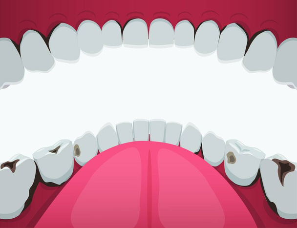 Зуби пошкоджені карієсом ротової порожнини. Чорні діри і тріщини зубів і розвиток зубного перелому
. - Вектор, зображення