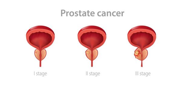 Stades cancer de la prostate. Perturbation de la glande mâle avec sa croissance en tumeur maligne altération de la fonction reproductrice. - Vecteur, image