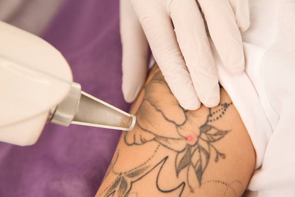 Young woman undergoing laser tattoo removal procedure in salon, closeup - Photo, image