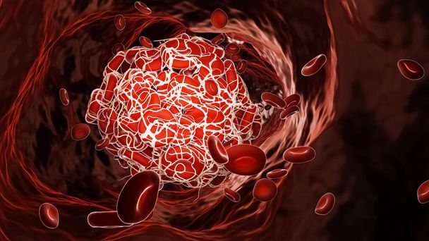 Trombus nebo krevní sraženina uvnitř cévy tekoucí s 3D zobrazením červených krvinek. Žilní trombóza, kardiovaskulární onemocnění, medicína, patologie, vědecké koncepty. - Fotografie, Obrázek