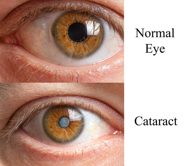 Vergleich eines gesunden menschlichen Auges mit einem Auge mit trübem Linsengrauen Star - Foto, Bild