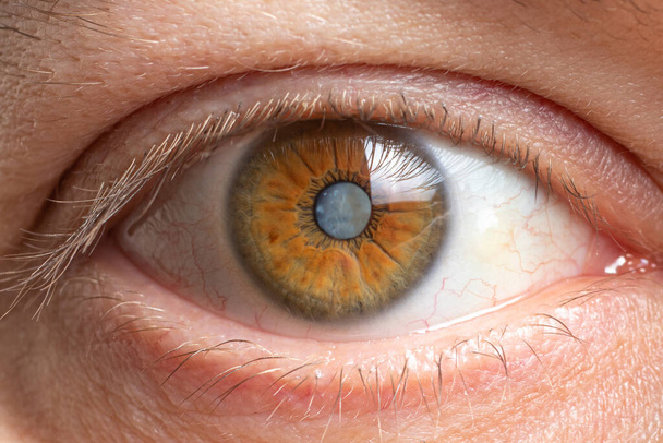 Macro foto dell'occhio umano - cataratta offuscamento della lente, deterioramento della vista. Trattamento della cataratta, chirurgia e oftalmologia - Foto, immagini