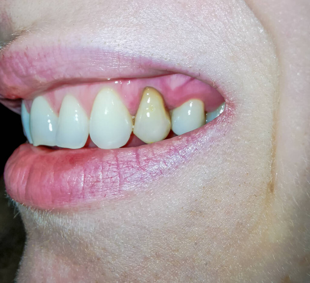 Decaying vrouwen tand veranderen van kleur - Foto, afbeelding