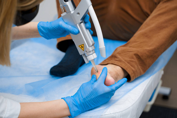 Eliminazione laser delle verruche sul piede. Chirurgia dermatologica medica in clinica. - Foto, immagini