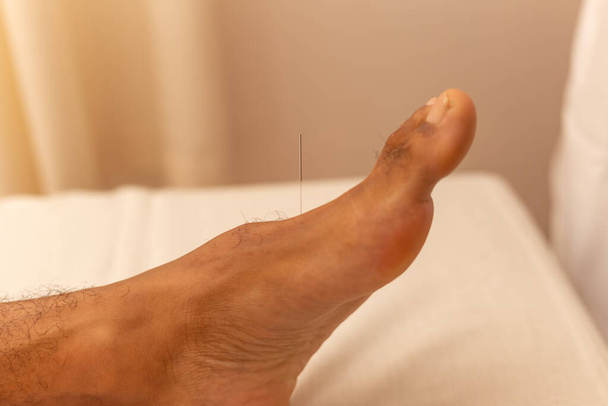  Szczegóły dotyczące igły akupunkturowej na stopie pacjenta. - Zdjęcie, obraz