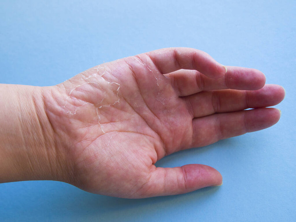 Een allergische reactie op de handen. Huidproblemen: het schilt af en klampt zich vast. - Foto, afbeelding