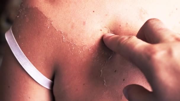 Extracción de la piel descamada de una quemadura solar. Retire la piel descamada después de la quemadura - Metraje, vídeo