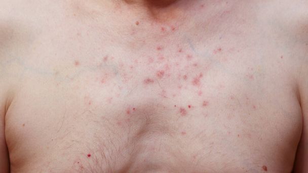 Реакция кожи на груди мужчины после химиотерапии. Аллергическая реакция. Аллергическая сыпь на коже груди - Фото, изображение