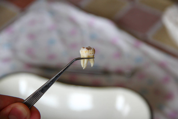 Extracted wisdom tooth in the tweezers - Photo, Image