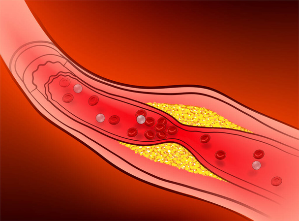 Arteries with clogged fat that causes blood clots. - Vector, Image