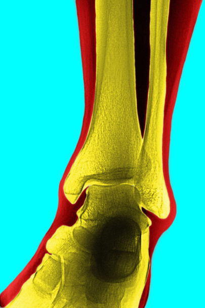 Röntgenbild des Schienbeins - Foto, Bild