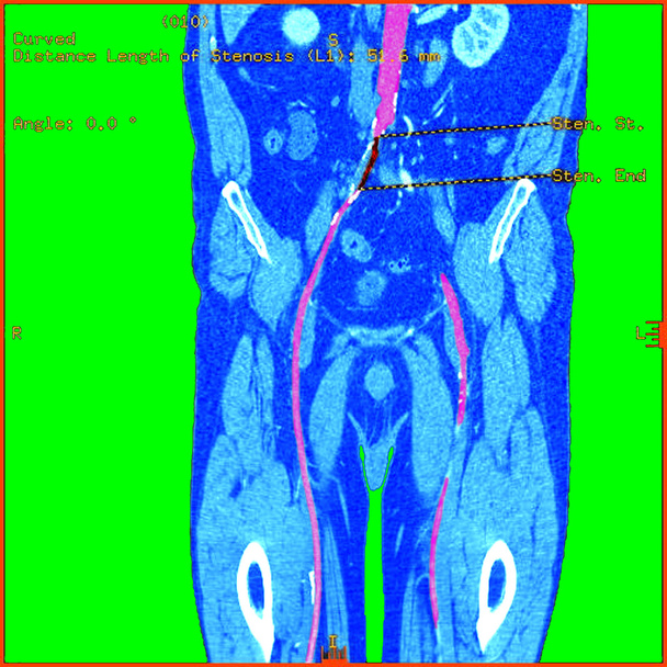 aorty brzusznej - Zdjęcie, obraz