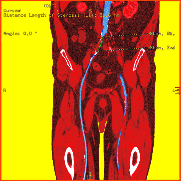 abdominal aort stenozu - Fotoğraf, Görsel