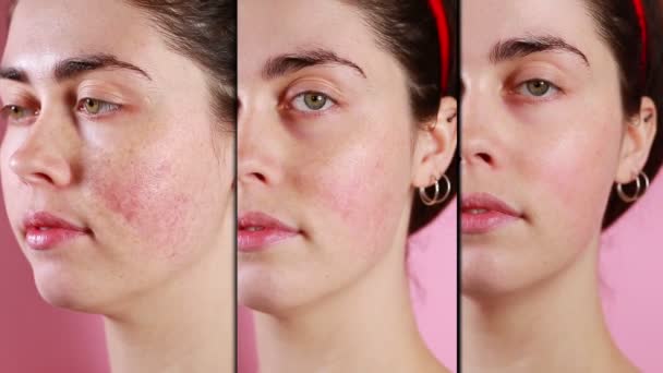 Egy fiatal kaukázusi nő arcának három fele mutatja az eredményt a rozácea-kezelés előtt és után. Osztott képernyő. Rózsaszín háttér. A kuszperóz és a rozácea fogalma - Felvétel, videó