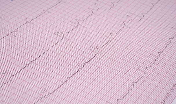 Primer plano Informe de la prueba ecocardiográfica (ECG) que muestra ritmo cardíaco anormal. - Foto, Imagen