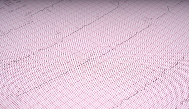Close Up Echocardiograph test report (ECG) che mostra ritmo cardiaco anormale. - Foto, immagini