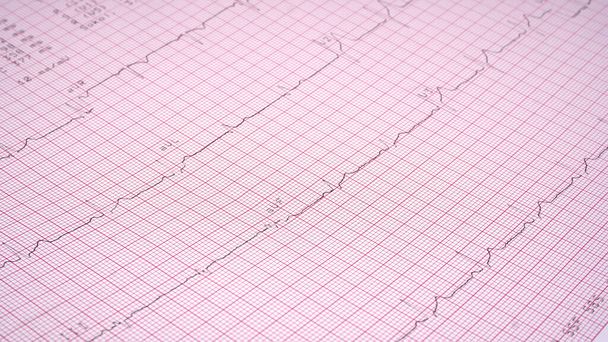 Close Up Echocardiograph vizsgálati jelentés (EKG) szívritmuszavart mutat. - Fotó, kép