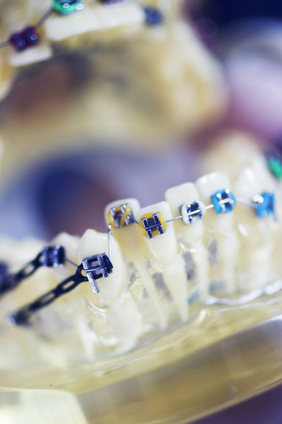 Support d'alignement de dents dentaires enseignant le modèle étudiant montrant les gencives et les redresseurs de dents métalliques. - Photo, image