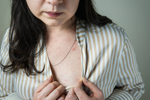 Frauen mit Symptomen einer juckenden Urtikaria oder einer allergischen Reaktion auf der Haut. Roter Hautausschlag am weiblichen Körper. Konzepte von Allergie, Hautkrankheiten und Gesundheitsfürsorge. - Foto, Bild
