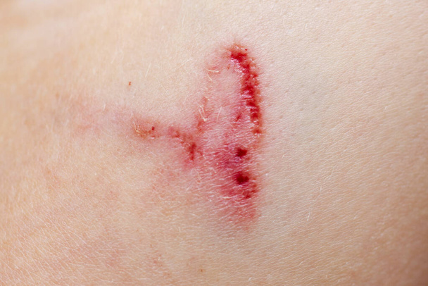 A wound on the human body, deep cut, scar closeup. Deep scratches on the skin with bruises. - Photo, Image
