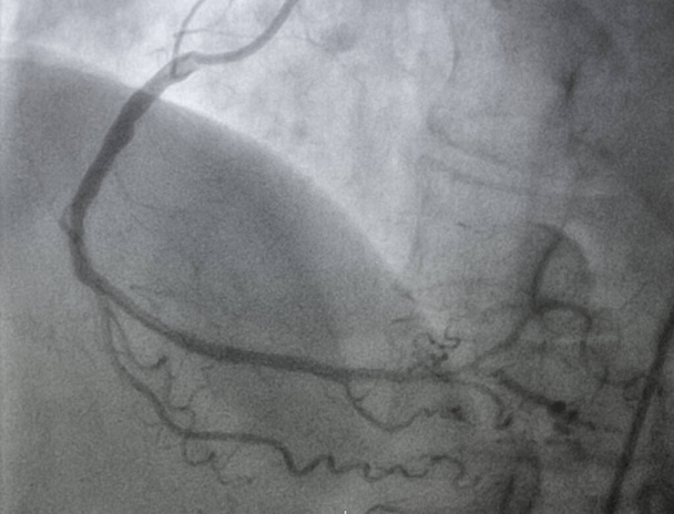 Coronary angiography , Right coronary artery disease. - Photo, Image