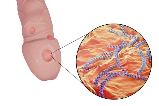 Wykonany wrzód ulcus durum i zbliżenie widok kiła Krętek blady bakterii na powierzchni penisa, ilustracja 3d - Zdjęcie, obraz