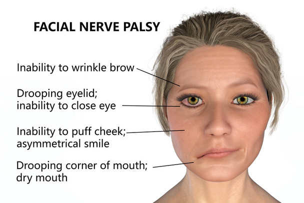 Paraliż nerwu twarzowego, porażenie Bella, ilustracja 3D pokazująca kobietę z jednostronnym paraliżem nerwu twarzowego - Zdjęcie, obraz