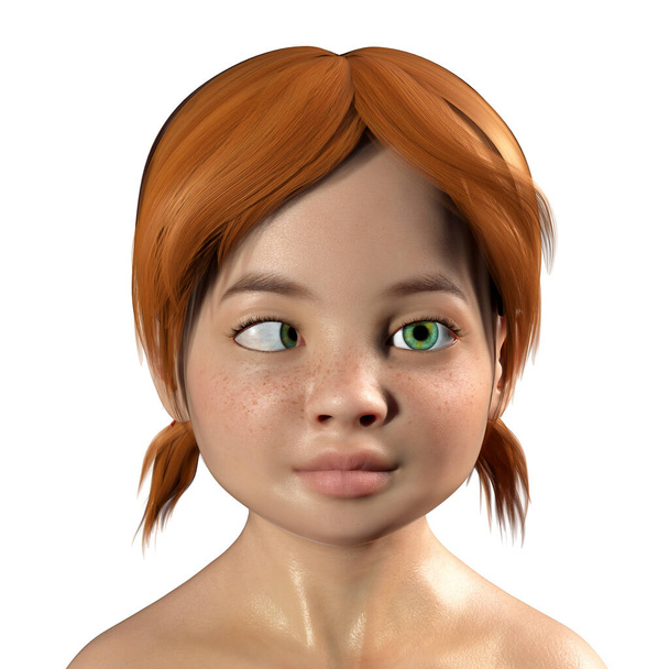 Çocuklarda strabismus, esotropiyi gösteren 3 boyutlu illüstrasyon, gözler içe dönükken bir tür göz sapması - Fotoğraf, Görsel