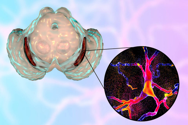 Чорна субстанція, базальна ганглія середнього мозку, при хворобі Паркінсона, 3D ілюстрація, що показує зменшення його об'єму та виродження дофамінергічних нейронів у компактному просторі чорної субстанції
 - Фото, зображення