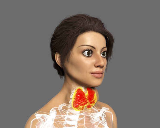 Schilddrüsenüberfunktion. 3D-Illustration zeigt vergrößerte Schilddrüse und Exophthalmus (pralle Augen) bei einem Weibchen mit Graves 'Krankheit, auch bekannt als giftiger diffuser Kropf - Foto, Bild