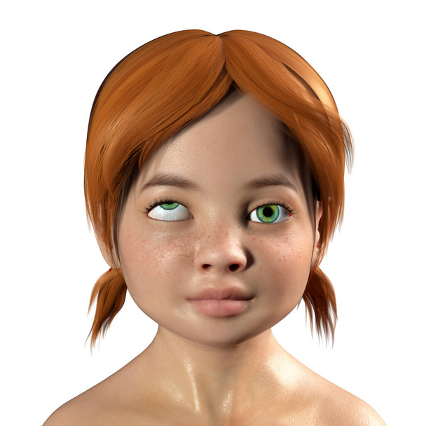 Strabismus bei Kindern, 3D-Illustration mit Hypertropie, einer Art Augenabweichung, wenn das Auge nach oben zeigt - Foto, Bild