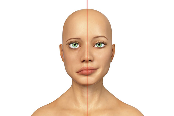 Gesichtsnervenlähmung, Bell-Lähmung, 3D-Illustration, die eine Frau mit einseitiger Gesichtsnervenlähmung zeigt - Foto, Bild