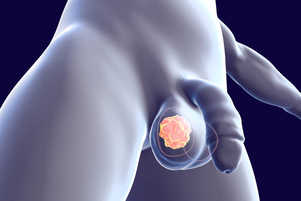 Conceito médico de câncer testicular. Câncer de testículo, ilustração 3D - Foto, Imagem