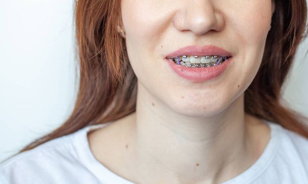 Zahnspange im lächelnden Mund eines Mädchens. Glatte Zähne aus Zahnspangen. - Foto, Bild