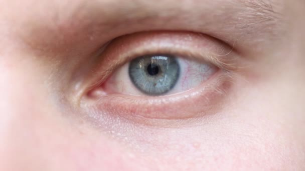 oog close-up, grijs-blauwe kleur, ontstoken haarvaten. - Video